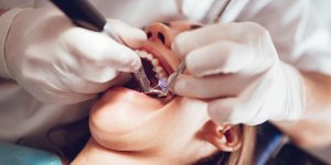 Parodontite : ce probleme dentaire qui augmente le risque de cancer