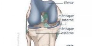 Rupture du ligament croise anterieur du genou (LCA) : Traitement chirurgical