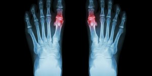 Arthrose du pied : la crise de goutte a l-orteil