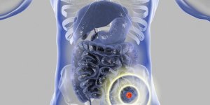 Cancer du colon : le nombre de cas parmi vos proches influence votre risque