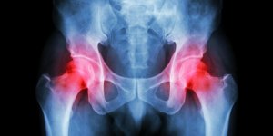 Arthrose de la hanche : les premiers symptomes