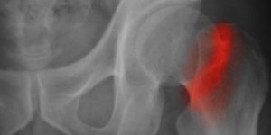 Maladie d’Alzheimer : la fracture de la hanche, un symptome precoce ?