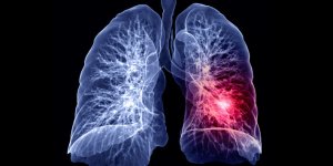Cancer du poumon : votre risque selon la region ou vous habitez