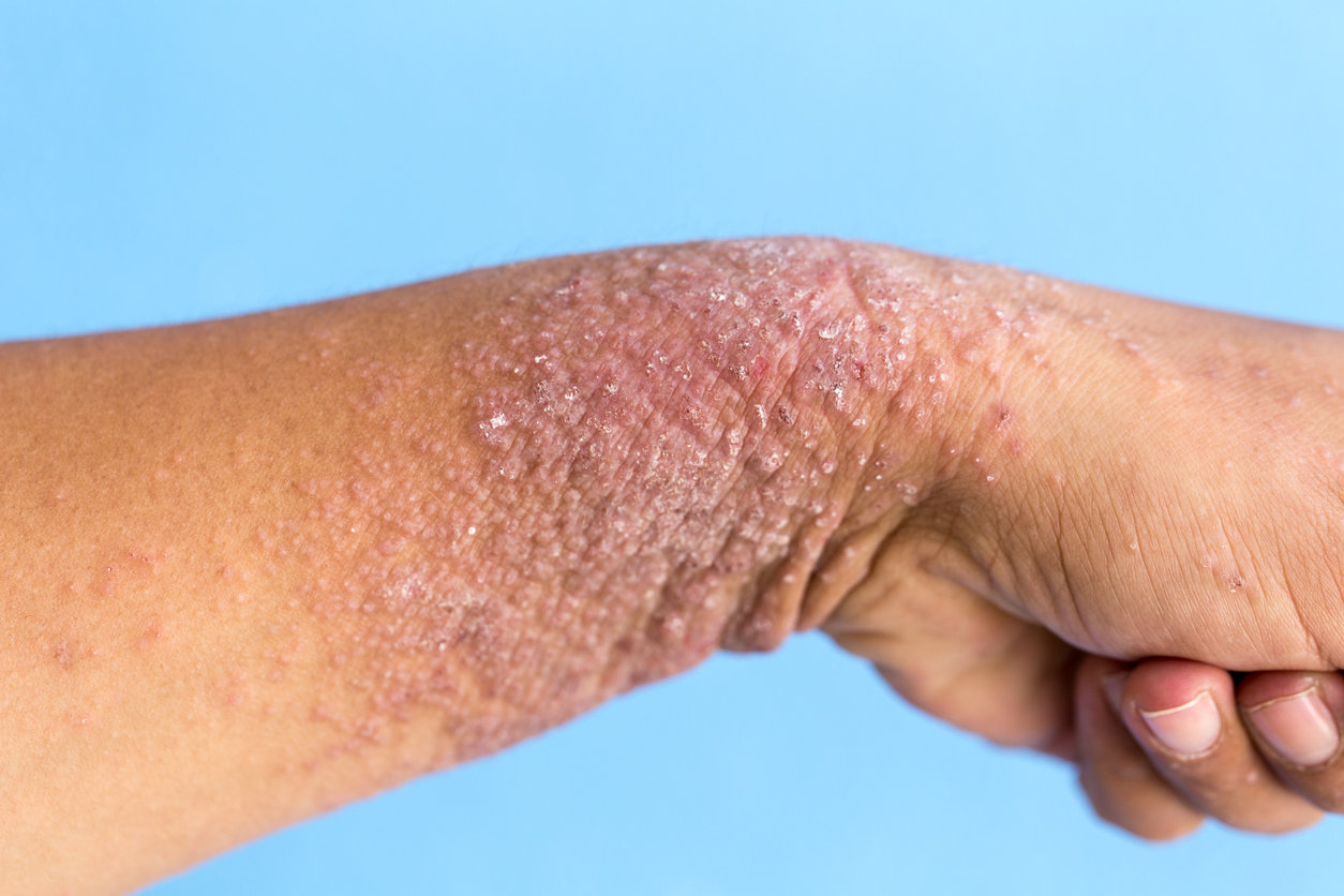 Dermatite atopique : comment la reconnaître pour mieux la traiter ?