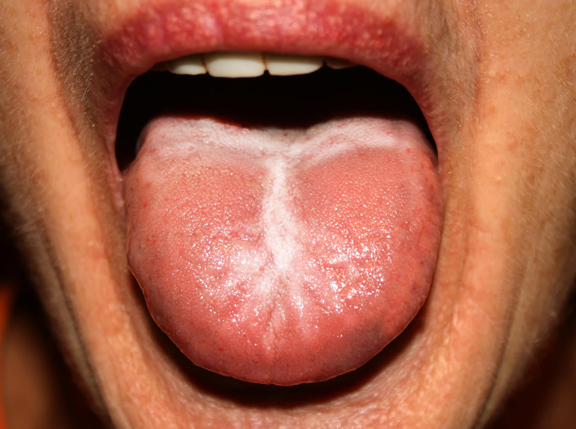 Mycose de la bouche : qu'est-ce que le muguet buccal ?