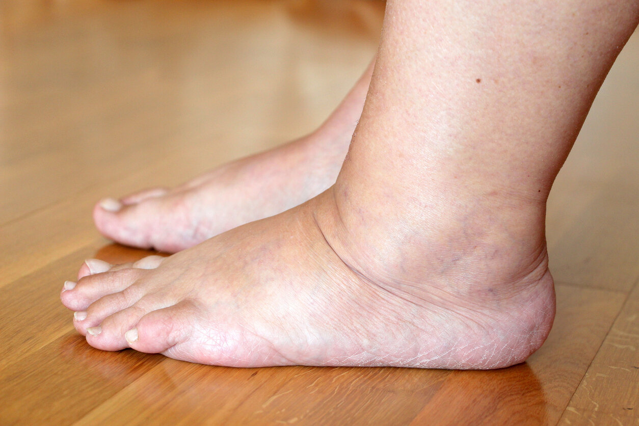 3 causes qui expliquent les pieds gonflés