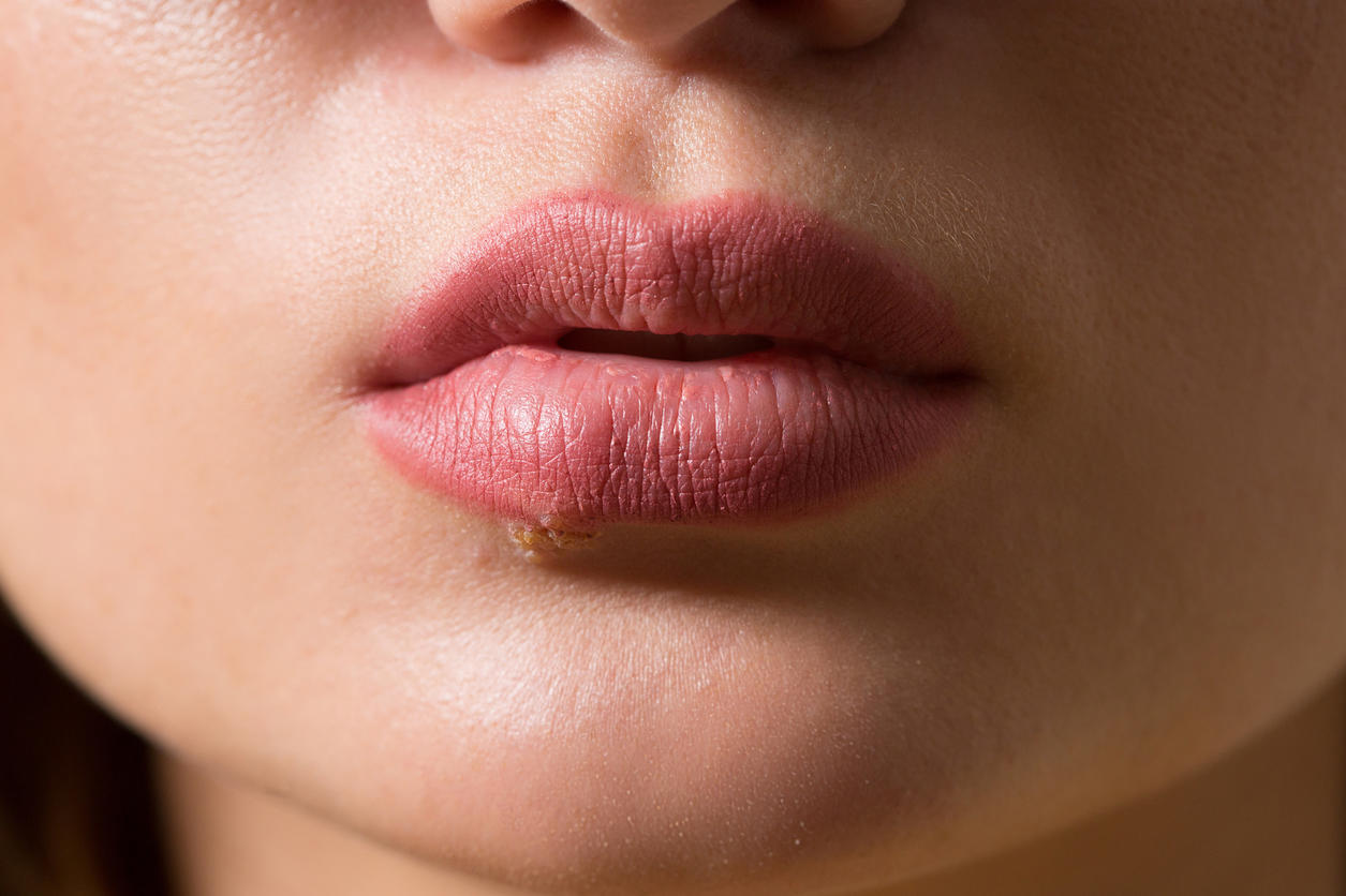 Aphte à la lèvre : comment le soigner ?