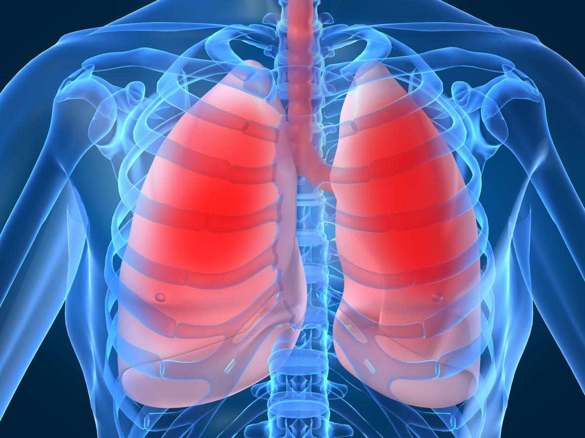 Embolie pulmonaire : des risques plus élevés en cas de cancer