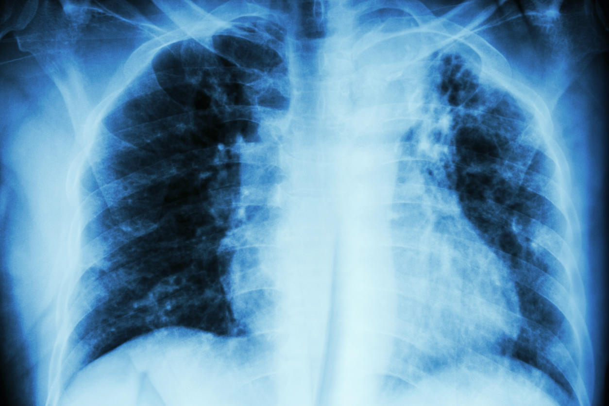 Tuberculose (pulmonaire, osseuse…) : symptômes, test, vaccin ...