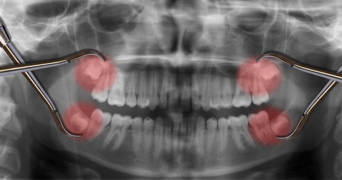 Mal aux dents de sagesse : jusqu'à quel âge ?