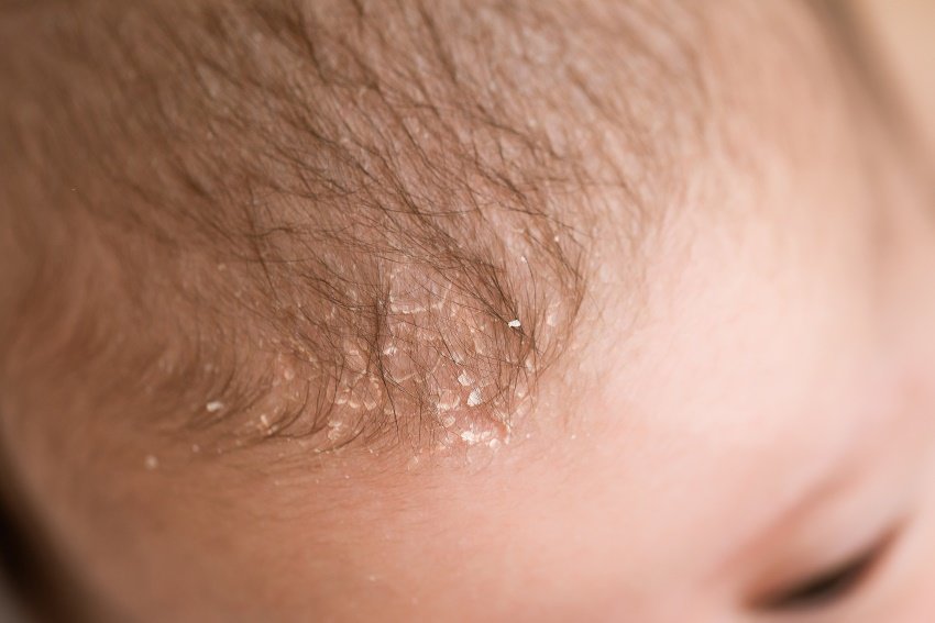 Dermatite séborrhéique : comment enlever les croûtes de lait de bébé ?