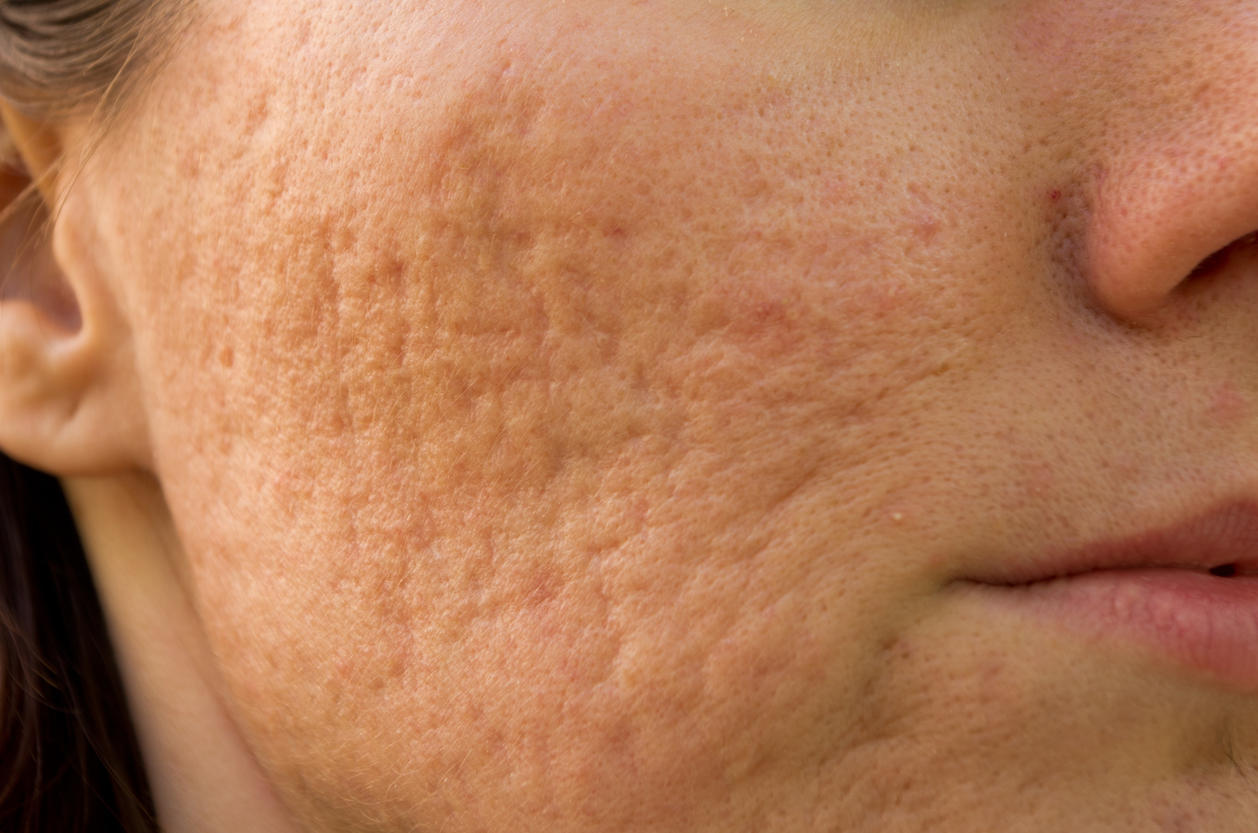 Peau granuleuse : un signe d'allergie au visage ?