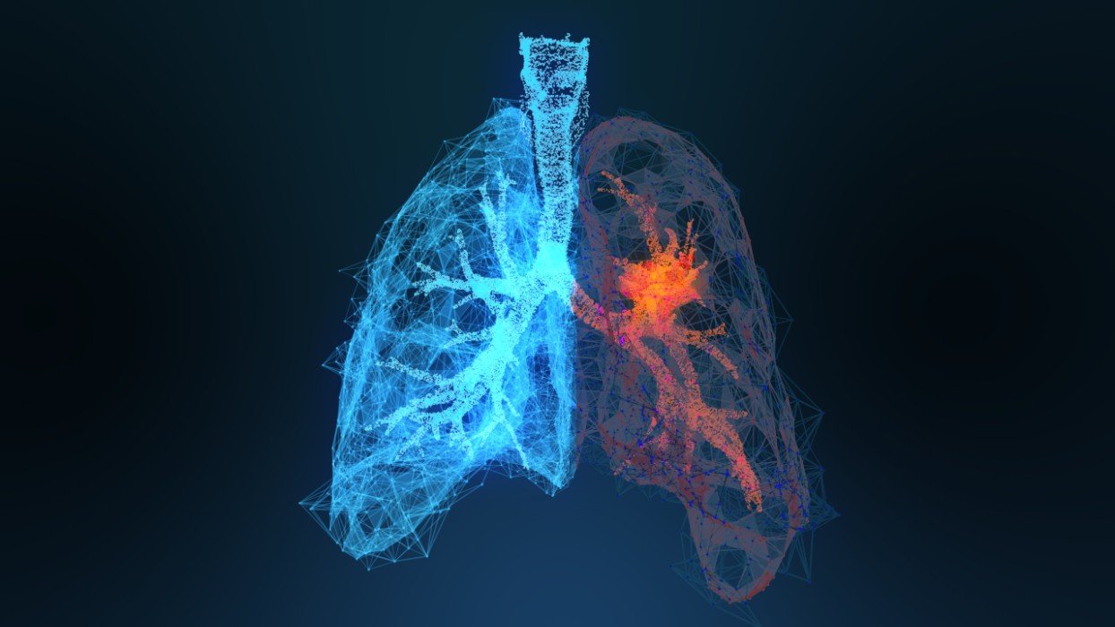 Cancer du poumon : 6 signes cutanés à repérer