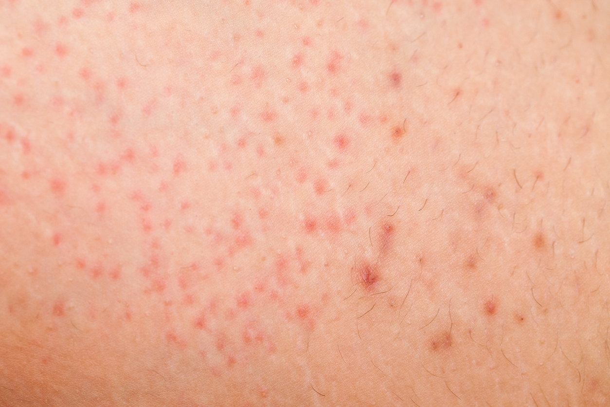 Ces petits boutons sur votre peau sont peut-être le signe d’une kératose  pilaire
