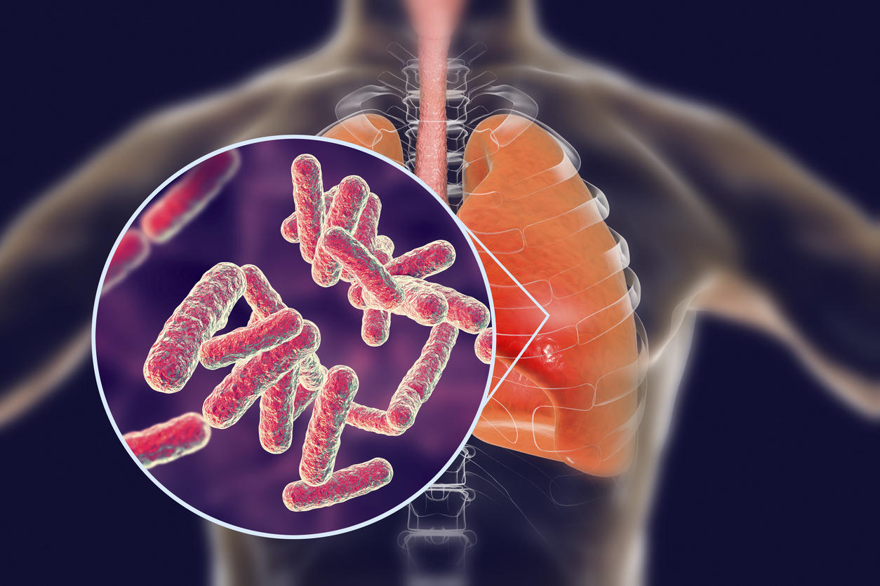 Pneumonie : symptômes, contagion, causes, traitements