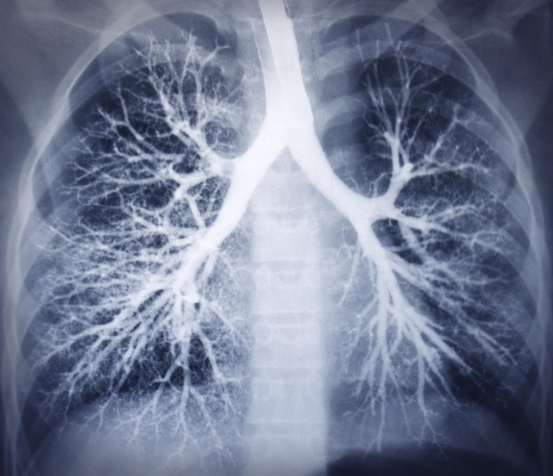 Cancer du poumon : quand un ganglion est-il dangereux ?