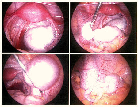 Photo : l&apos;endométriose vue lors d&apos;une chirurgie laparoscopique