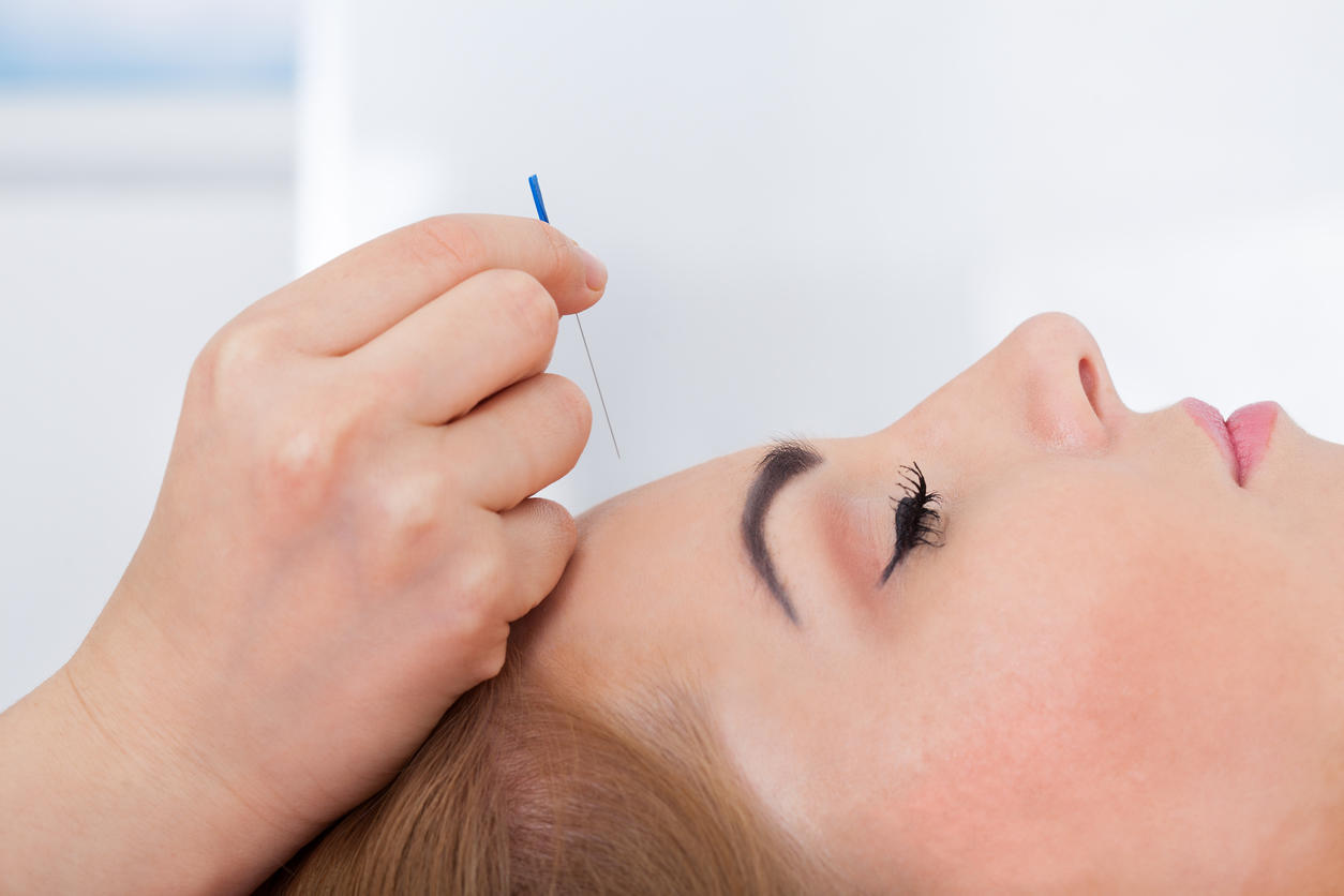 L’agopuntura è una cura miracolosa per il mal di testa?