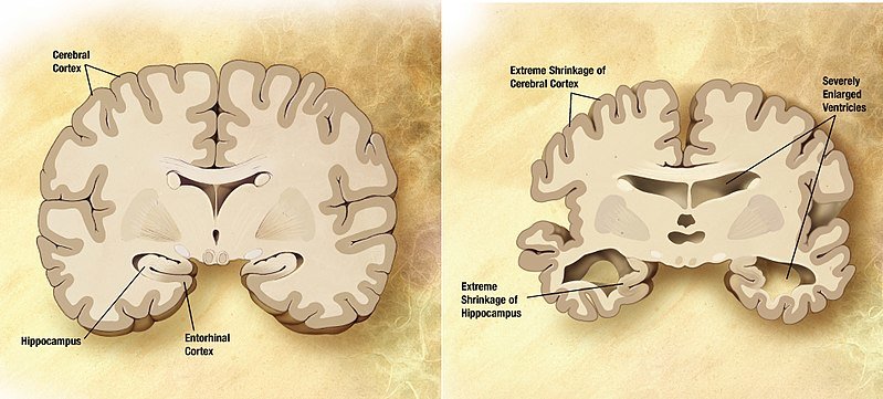 Schéma d&apos;un cerveau sain à gauche et d&apos;un cerveau atteint par la maladie d&apos;Alzheimer à droite :