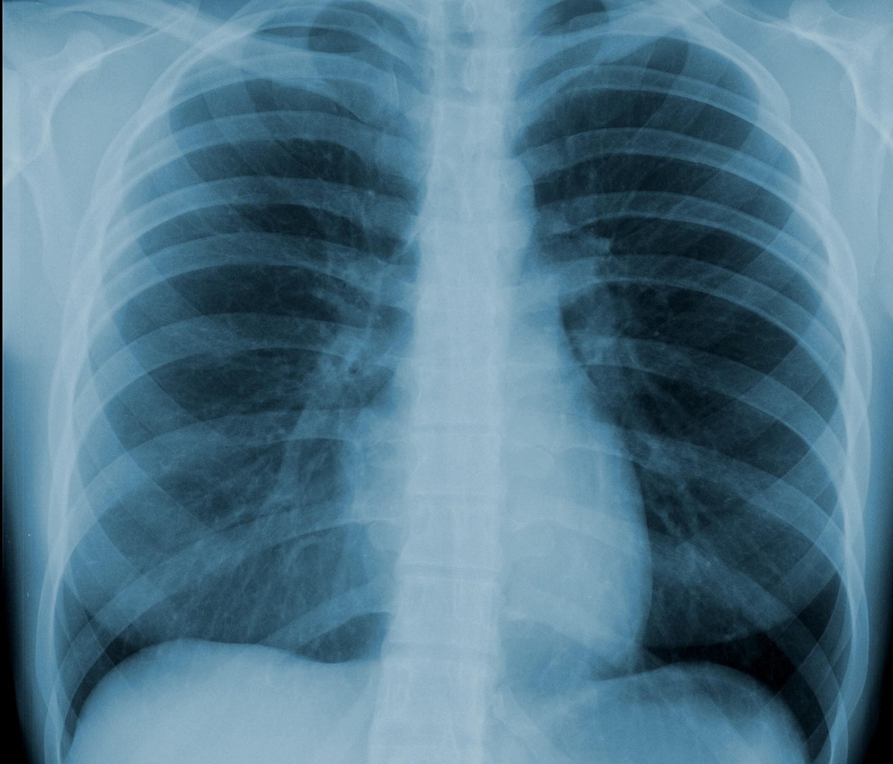 Métastase pulmonaire : les signes