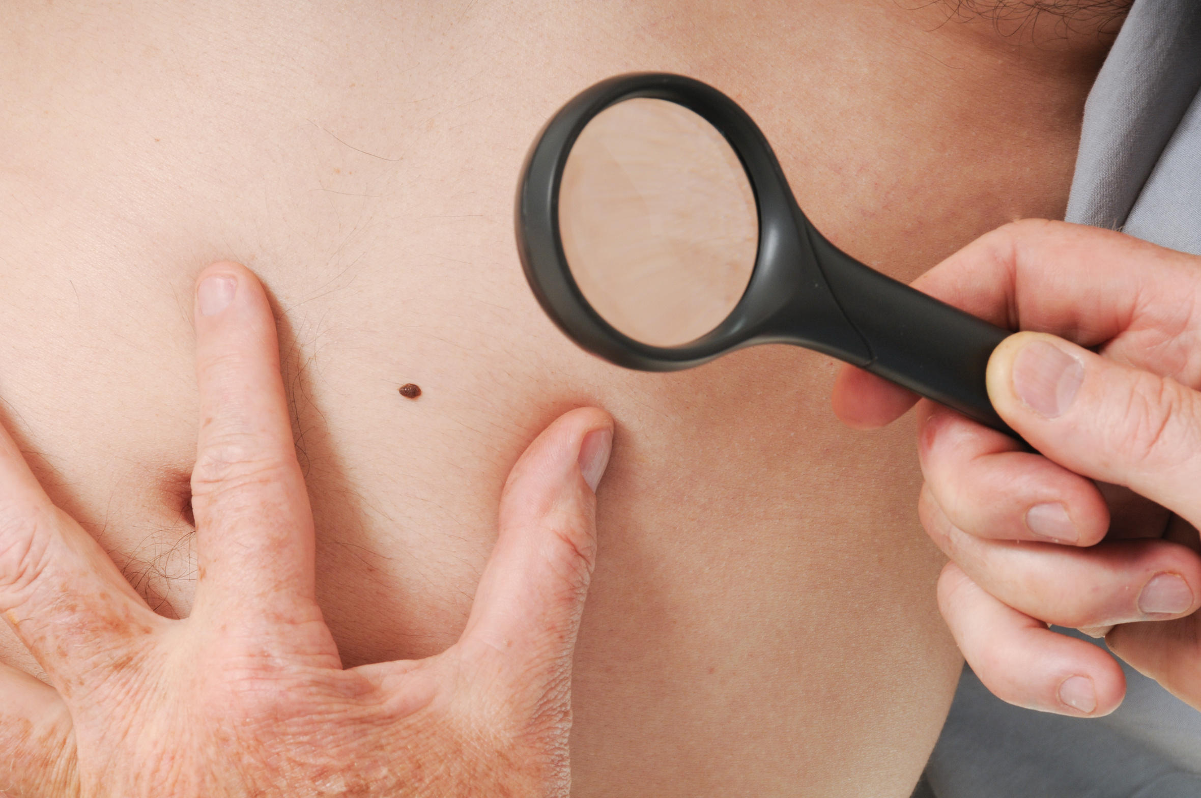 Cancer de la peau : 4 photos qui doivent alerter
