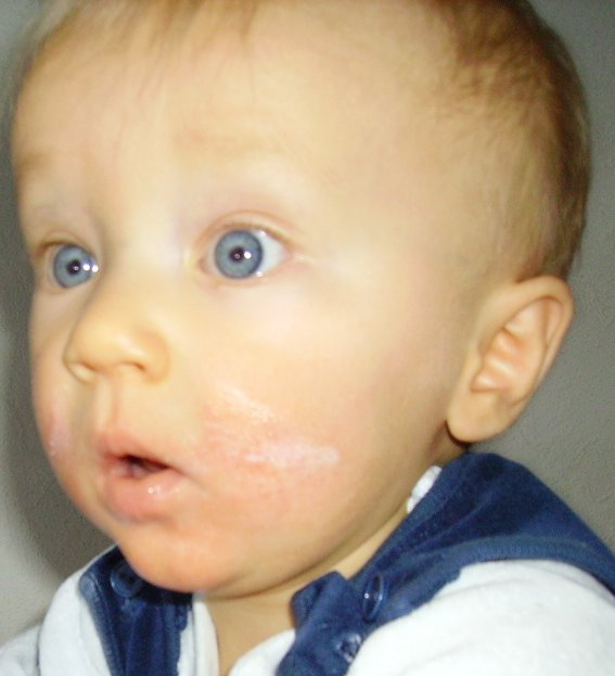 La dermatite atopique chez le nourrisson et le bébé 