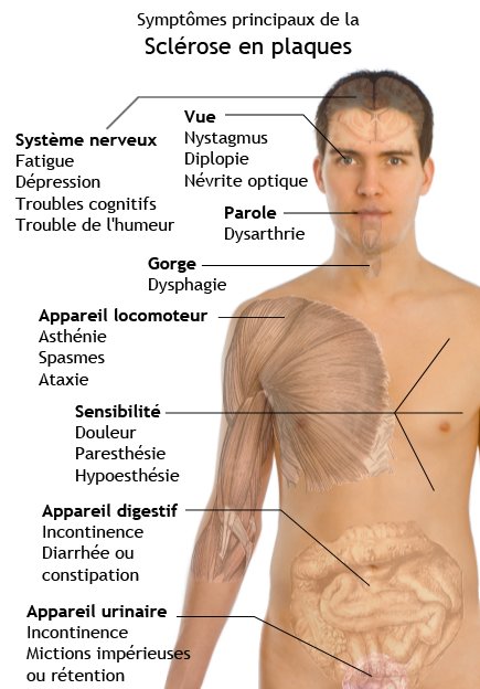 Quels sont les symptômes de la sclérose en plaques ?