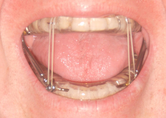 Traitement par orthèse d&apos;avancée mandibulaire ou gouttières anti-ronflements