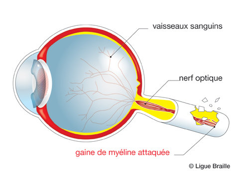 Qu’est-ce que la névrite optique ?
