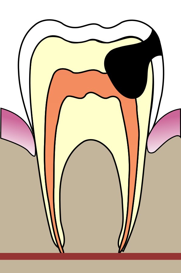 Quelle est la cause la plus fréquente de rage de dents ?