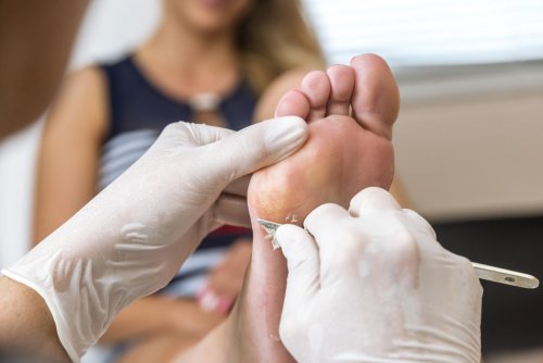 chiropodist removes skin on a wart with a scalpel on the sole of foot of a woman