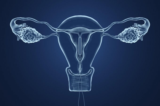 Le stérilet favorise-t-il le cancer du col de l’utérus?