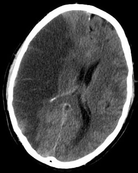 Photo : scanner cérébral montrant un accident vasculaire cérébral