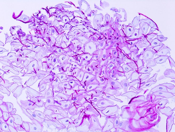 Mycose buccale : peut-on la prévenir ?