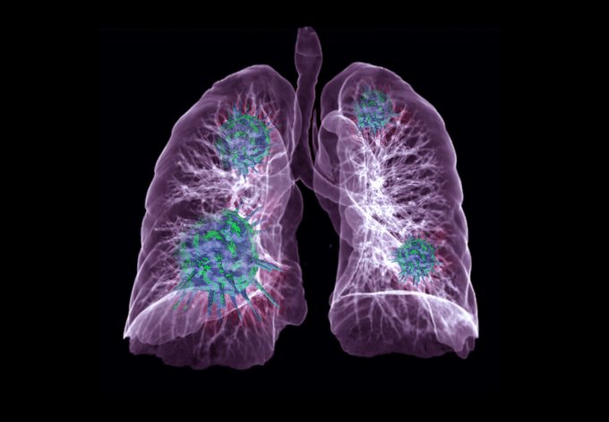Comment déceler une embolie pulmonaire ? 