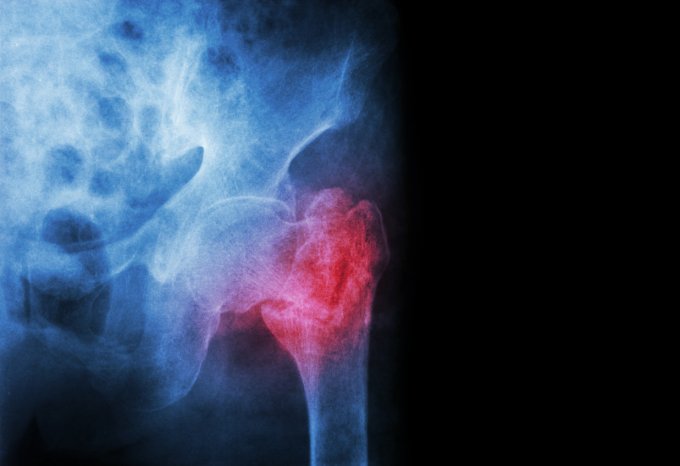 Perte de poids brutale : gare à l’ostéoporose