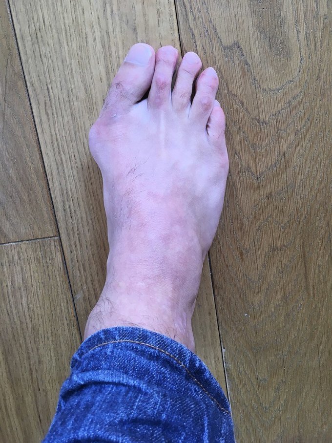 Photo : Hallux valgus