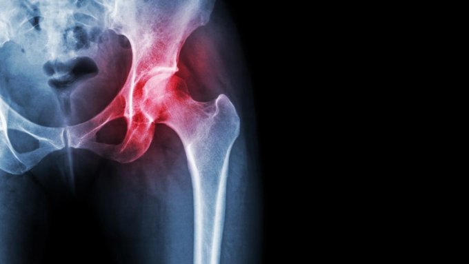 Les raisons de la pose d’une prothèse de hanche