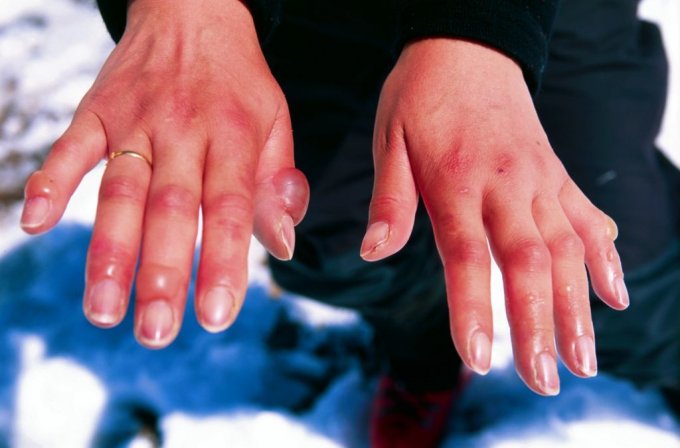Photo : des engelures au niveau des doigts et des orteils