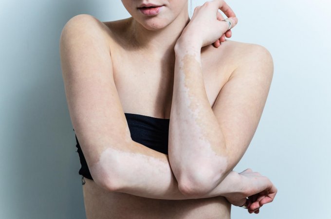 Des taches blanches : vitiligo ou pityriasis