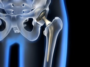 La prothèse de hanche si l&apos;arthrose résiste aux traitements