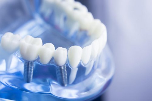 Prothèse dentaire : attention à la fonte osseuse