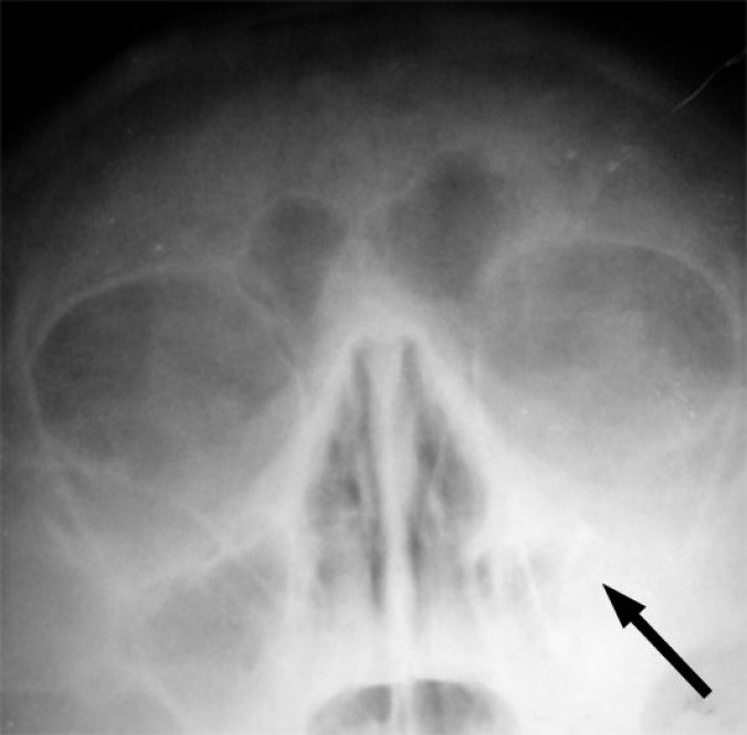 Photo : sinus maxillaire gauche marqué d&apos;une flèche