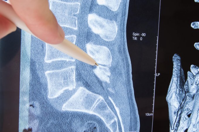 photo mri lumbosacral spine pathology radiologist indicated on possible pathology or disease of image of spine lumbosacra...