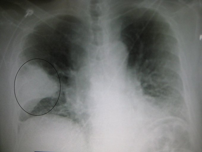Une pneumonie sévère du lobe du poumon droit :