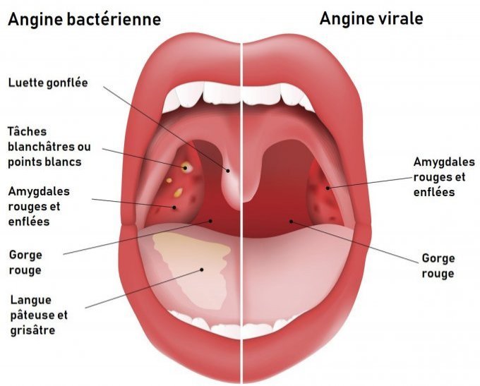 Angine rouge ou blanche : comment faire la différence ?