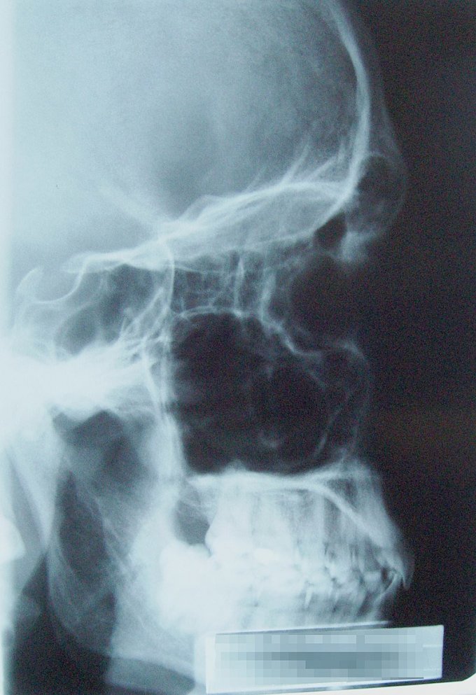 Photo : sinus paranasaux (en noir sur la radiographie car remplis d&apos;air)