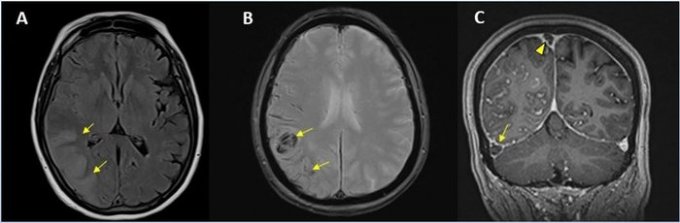 Image d&apos;une hémorragie cérébrale observée chez une femme de 56 ans atteinte de la covid-19