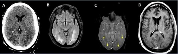 Image des complications cérébrales observées chez un homme de 65 ans atteint de la covid-19 