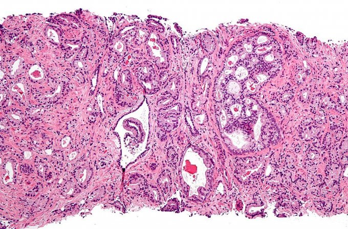 Photo : micrographie montrant un adénocarcinome acineux de la prostate (la forme la plus courante de cancer de la prostate) 